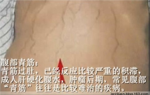 人体体表“青筋”凸起意味着什么? - 红杏妹--红杏妹